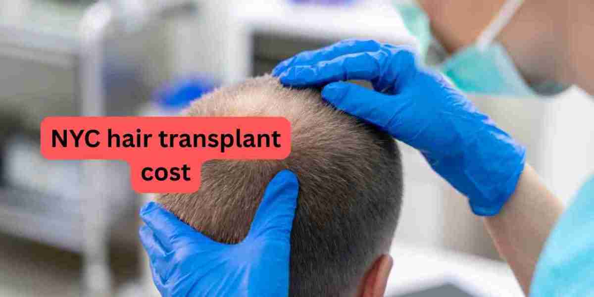 Affordable NYC Hair Transplant Cost Guide