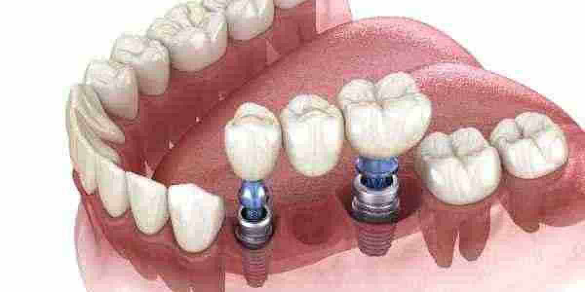 How Stress Affects Oral Health in Aberdare
