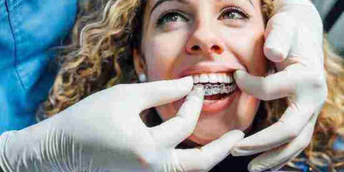 Invisalign Attachment Points That Guide Tooth Correction