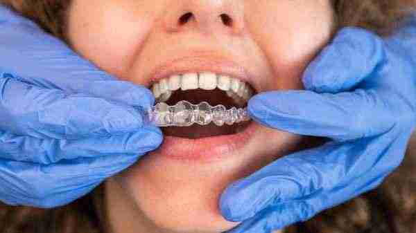 Discover how discreet aligners can transform your smile and boost dental health with ease, no brackets, no hassle.