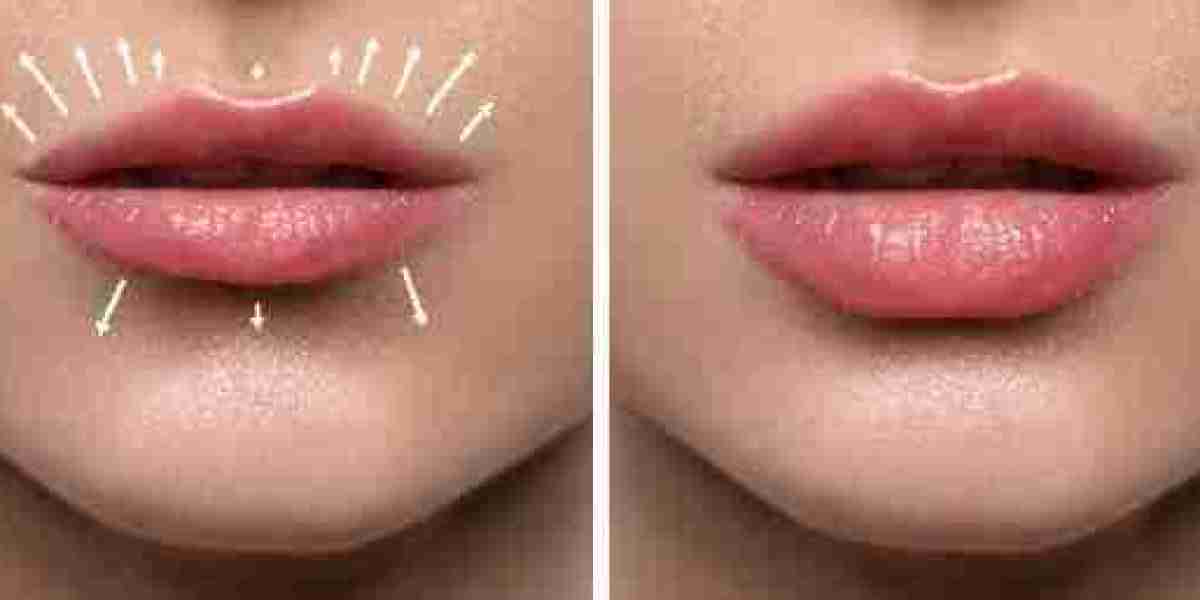 Create a Bold and Defined Look with Lip Filler Treatment