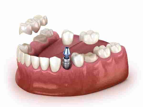 dental Implant Earlsfield